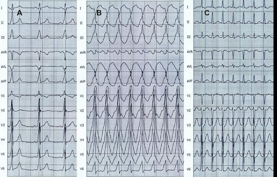 EKG 3A-C