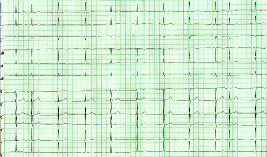 EKG 7