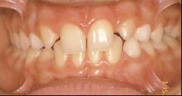 hypodoncie pravidelný počet zubů je zmenšen (zárodky nejsou založeny), ageneze je výraz pro nezaložení jednotlivého pravidelného zubu, oligodoncie je nezaložení skupiny (šesti a více) zubů a