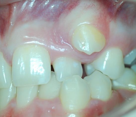 anomálie postavení zubů: rotace, inklinace zub prořezal na správném místě v zubním oblouku, ale je dlouhou osou otočen (rotace) meziálně či distálně nebo skloněn (inklinace) meziálně, distálně,