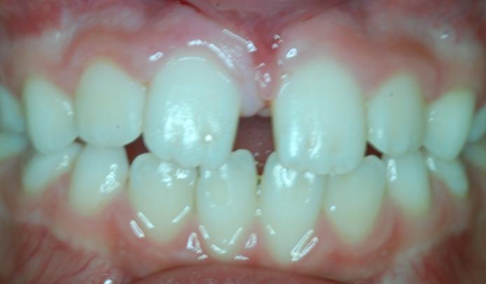 posun zubu stav, kdy je zub posunut mimo své místo meziálně, distálně, vestibulárně nebo orálně, avšak osa zubu je zachována retence (zadržení) zubu zub neprořezal do dutiny ústní (nejčastěji kvůli