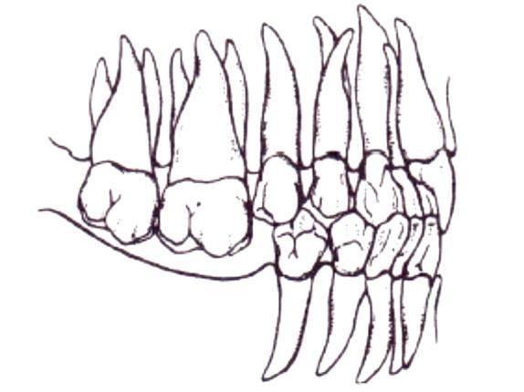 Obr. 16 Ztrátou antagonistů se zuby dostávají do supraokluze (Zdroj: Kilian et al., 1999) 3.3.3.6. Zadržená erupce zubů Nedostatečně prořezaný první stálý molár může být zadržený distální plochou dočasného druhého moláru.