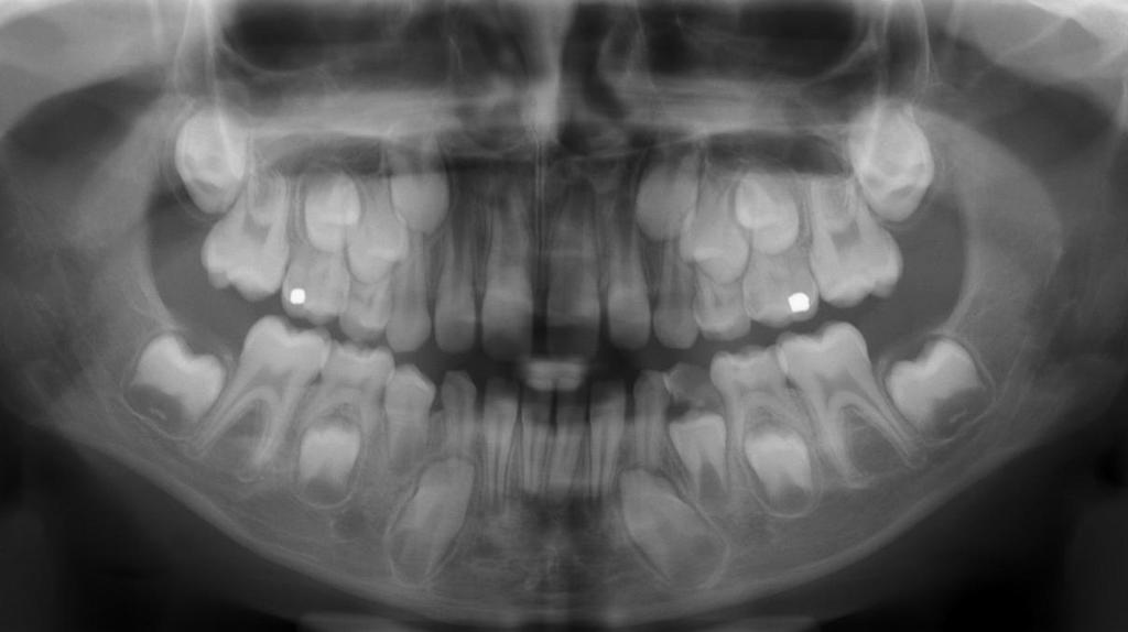 Bohumíra Chadima v Jablonci nad Nisou) Stálý chrup je kompletně založen, zárodky zubů 18, 28, 38