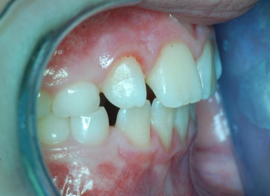 mezi zuby 11, 12 a mezi zuby 21, 22 (Zdroj: Archiv