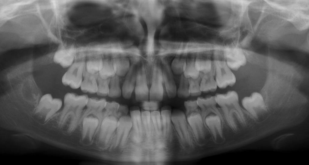 Bohumíra Chadima v Jablonci nad Nisou) Z rentgenového snímku je zřetelné, že stálá dentice je kompletně založená,