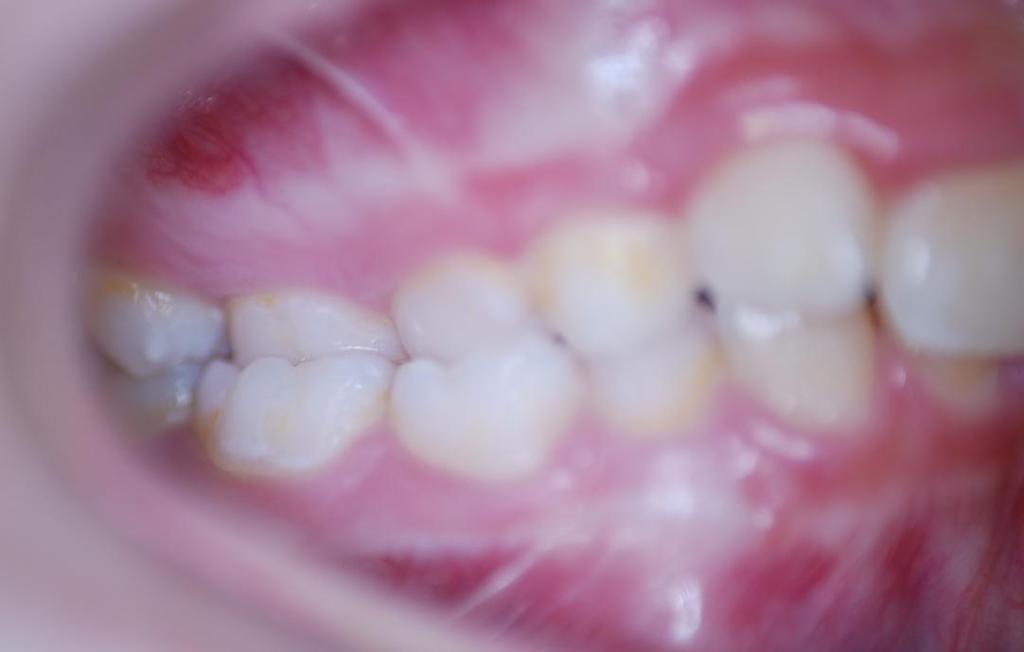 Obr. 36 Pacient 4: Převislý skus, retruze zubů 11 a 21, protruze