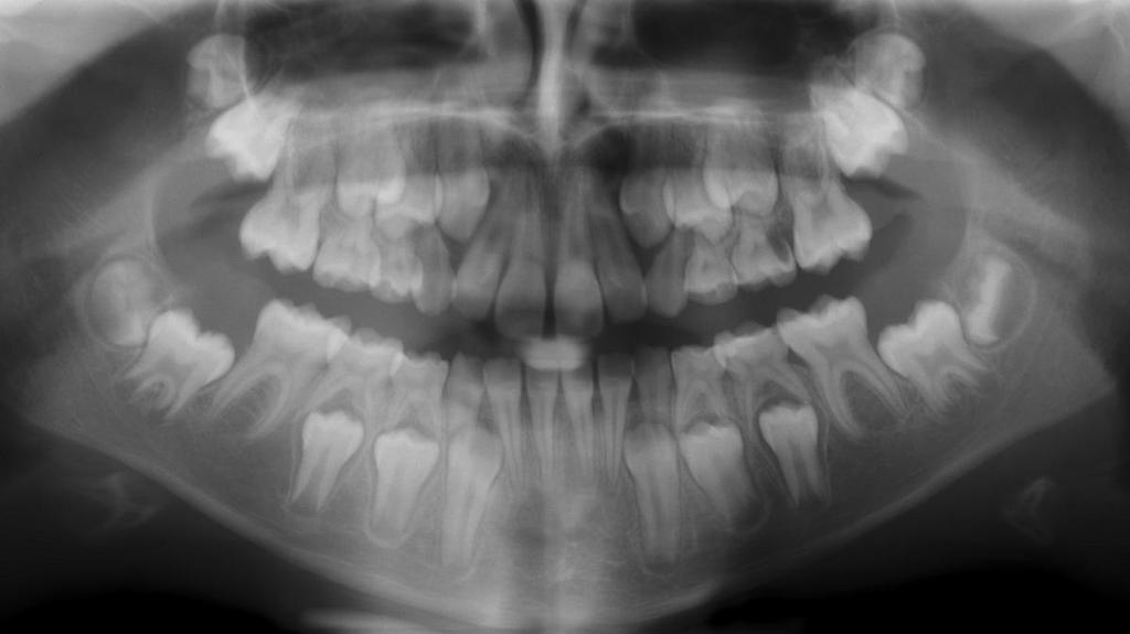 Bohumíra Chadima v Jablonci nad Nisou) Z rentgenového snímku lze odečíst, že chrup stálé dentice je kompletně