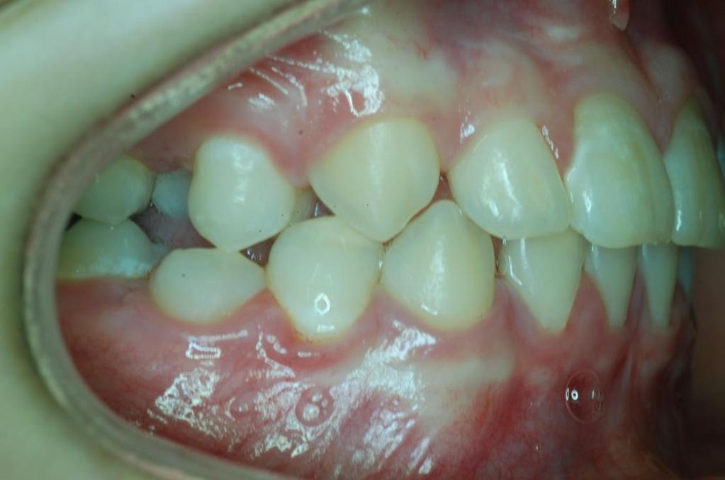 Obr. 50 Pacient 8: Předčasná ztráta zubu 55, sekundární stěsnání,