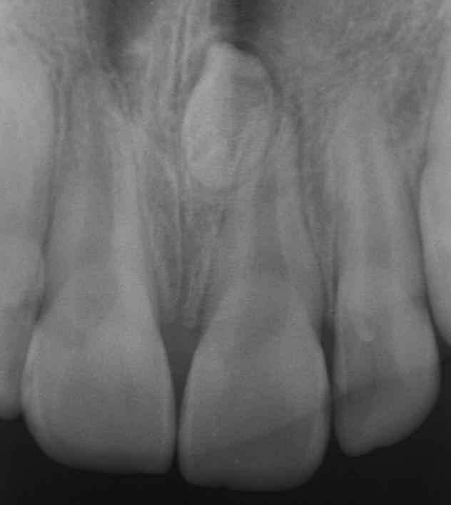Obr. 52 Pacient 8: Mesiodens zobrazený na intraorálním snímku (Zdroj: Archiv ordinace MUDr.