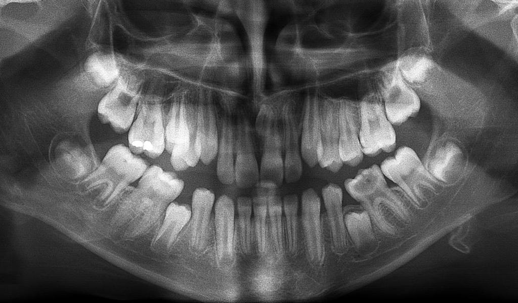 Bohumíra Chadima v Jablonci nad Nisou) Na snímku lze vidět, že všechny zuby stálé dentice jsou kompletně založeny a