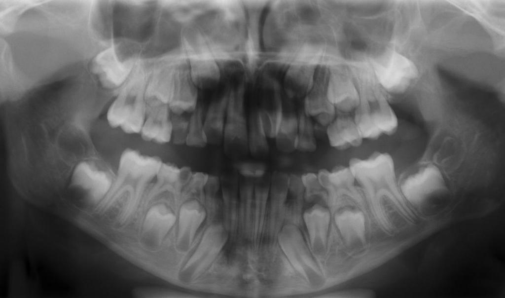 Bohumíra Chadima v Jablonci nad Nisou) Na snímku lze pozorovat, že stálá dentice je kompletně založená,