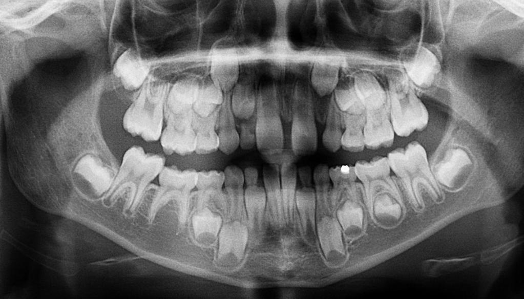 Bohumíra Chadima v Jablonci nad Nisou) Zárodky zubů 18, 28, 38 a 48 nejsou na rentgenovém snímku zřetelné.