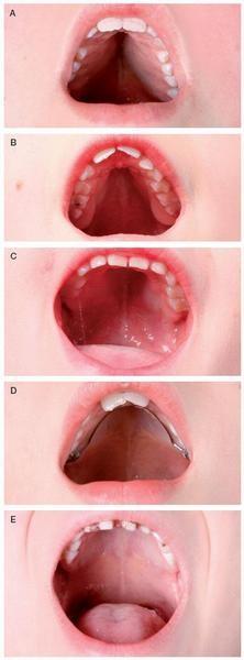 Gotické patro častější obtížná intubace častější abnormality d.