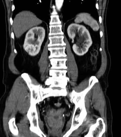 Obr. 1. Tumor ledviny, CT snímek, arteriální fáze, koronární Fig. 1. Renal tumor, CT image, arterial phase, coronar Obr. 2.