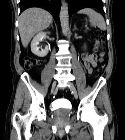 Obr. 3. Tumor močového měchýře, CT snímek, vylučovací fáze, koronární Fig. 3. Bladder tumor, CT image, excretory phase, coronar Obr. 4.