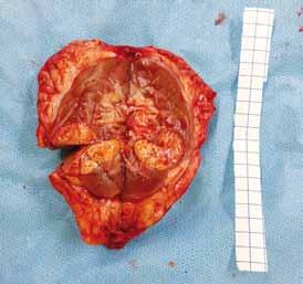 Renal tumor, photography of preparate after radical nefrectomy strana 46 panze báze močového měchýře a zřetelně zvětšené prostaty, bez nálezu maligně