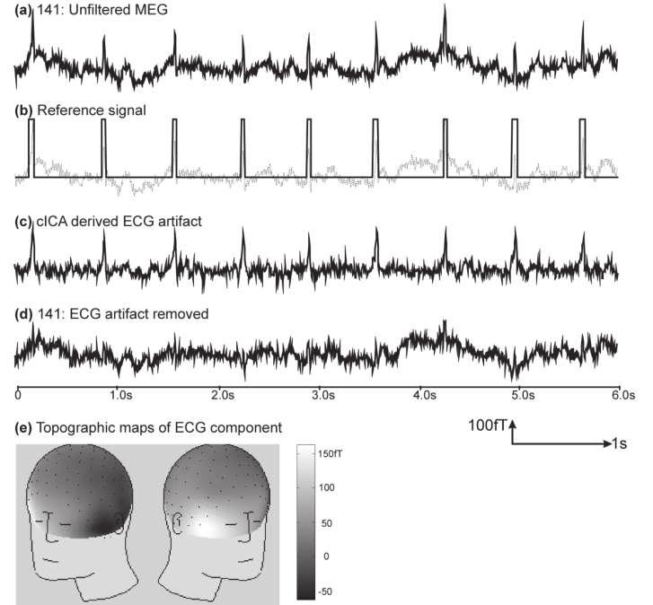 Lukáš Ručkay 31 způsobem. Autoři zvolili korelaci. Obrázek 2: Odstranění ECG artefaktu z EMG pomocí cica(levý obrázek). Referenční signál je získán prahovaním měřeného signálu.