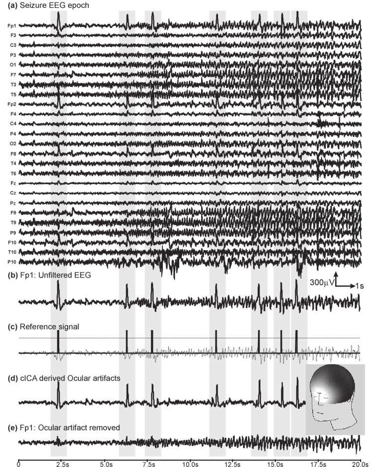 32 Lukáš Ručkay Obrázek 3: Odstranění EOG artefaktu z EEG dat(levý obrázek). Postupné odstraňování síťového,eogaecgartefaktuzmegdat(pravýobrázek).převzatoz[2].