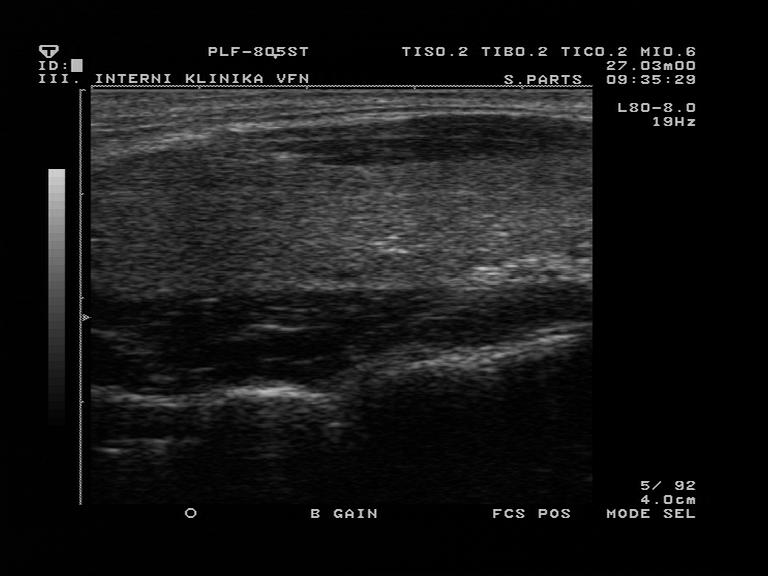 Sonogram štítné žlázy v podélném řezu zdravá lymfocitická