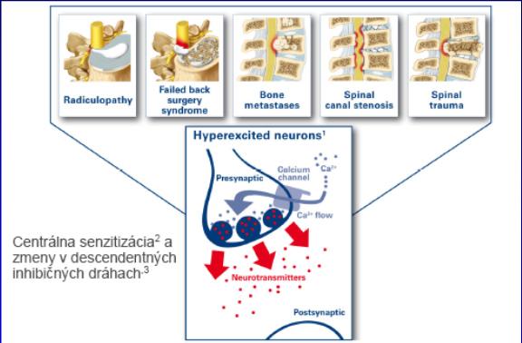 Neuropatická bolesť Charakteristické črty neuropatickej