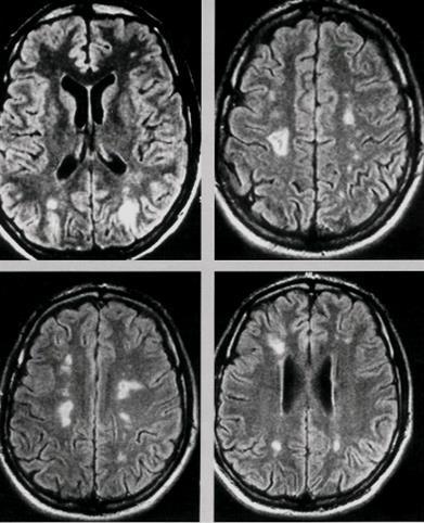 ZOBRAZOVACÍ METODY DIAGNOSTICKÉ METODY výhodné zejména při postižení CNS a