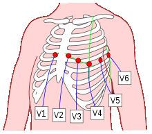 Porovnávají se tedy pouze k hodnotě Wilsonovy svorky. Značí se V1 až V6, a elektrody se umisťují se na místa: V1 4. mezižebří, vpravo od sterna V2 4.