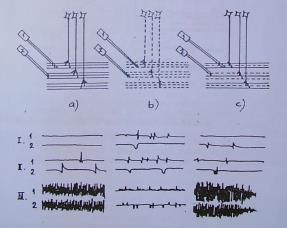 ELEKTROMYOGRAM EMG záznam I) svalu v klidu II) s mírnou kontrakcí III) se silnou kontrakcí a)