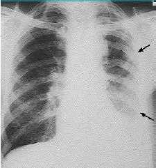 primární nádor pohrudnice s vysokou agresivitou hlavní příčinou je kontakt s azbestem diagnostika - imunohistochemické vyšetření vzorku nádoru léčba - chemoterapie (medián přežití 4-12 měs.