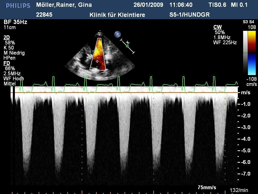 reflux 7m/s = 196 mm Hg krevní