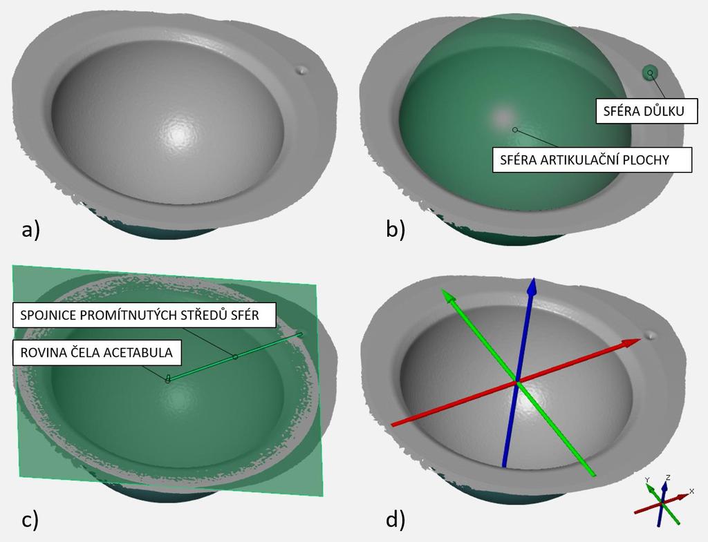 MATERIÁL A METODY skenování z povrchu acetabula důkladně odstraněn v ultrazvukové čističce. Garantovaná přesnost měření touto metodikou se pohybuje v rozmezí 3 5 µm. [42] 4.6.