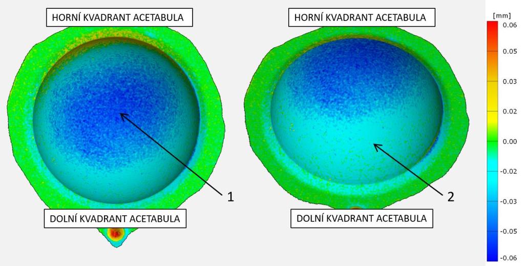 VÝSLEDKY Obr. 5-4 Stlačení artikulační plochy acetabula 5.2.