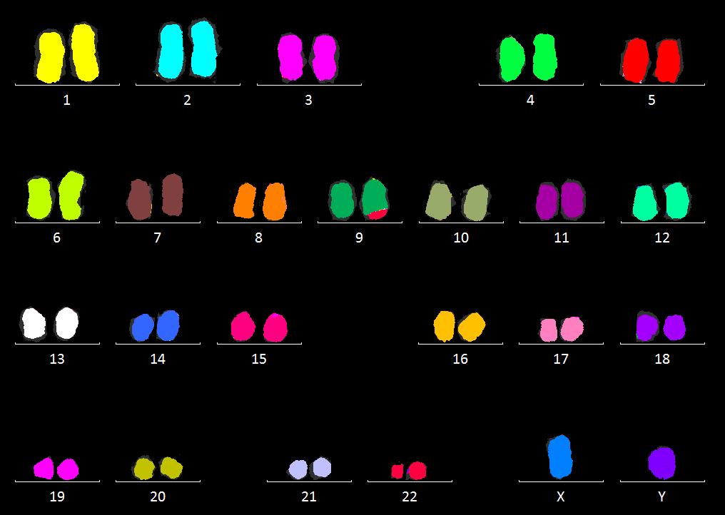 Obr.2.: Cytogenetický nález translokace: karyotyp 46