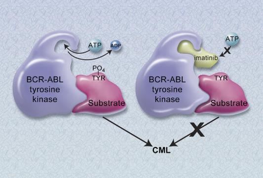 Obr.6:Mechanismus působení Imatinibu na BCR/ABL tyrosin kinázy (Druker et al., 2001) Od roku 2003 (Fausel, 2007) je Imatinib pacientům podáván v první linii léčby CML.