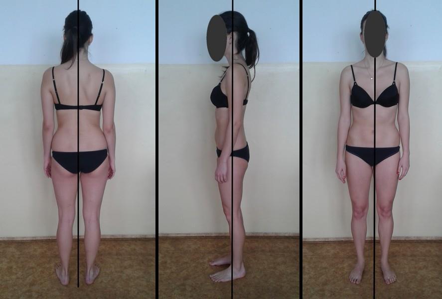 Při palpačním vyšetření došlo k vymizení reflexních změn v levém m. trapezius a m. pectoralis major, dále se zmenšil hypertonus v oblasti mezilopatkových svalů.