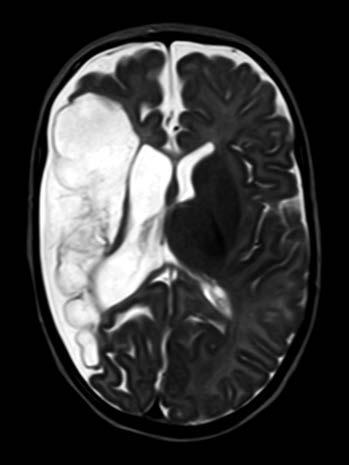 Obr. 1. Rozsáhlá cystická encefalomalacie pravé mozkové hemisféry, kopírující povodí a. cerebri media (MRI, T2-vážené zobrazení) Obr. 2.