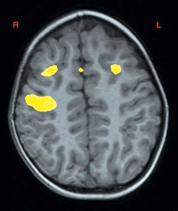 Kritéria pro referování pacientů do dětských epileptologických center (převzato z Arzimanoglou et al.