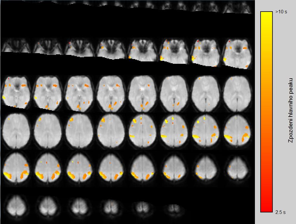 Obr. 5.9: Příklad variability HRF č.