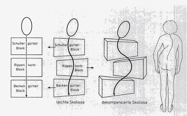 Příloha 14 - Rozdělení těla do bloků podle K. Schrothové a jak se mění při skolióze Zdroj: SCHROTH, Ch. L.
