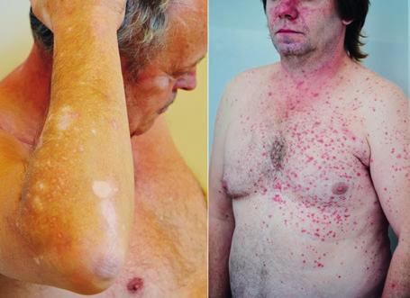 Aktulity Or. 3, Kožní nežádoucí účinky léčy pemrolizumem: () vitiligo, () ppulózní exntém s pruritem. Výskyt vitilig ěhem léčy ývá spojován s lepší účinností léčy nti PD1. Or. 4, Klinický orz před zhájením léčy ipilimumem.