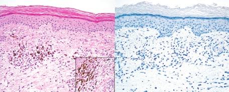 T. 1 Mutční nlýz exprese PD-L1 z primárního tumoru pcient směrem ventrálním i kudálním v téže doě se ojevil i hmtná rezistence n krku preurikulárně vlevo o velikosti 3 cm 2 cm (or. 4, ).