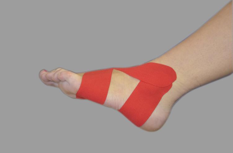 Obrázek 8: Výsledný kineziotape (Štědrák, 2012) 2 foto z kurzu Kineziotaping II 5.3 