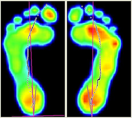 Obrázek 14: Detailní tlaková mapa jednotlivých došlapů na desce Footscan (zdroj obrázku vlastní) Spolu s rozložením tlaku je na obrázku 14 vidět i znázorněná osa