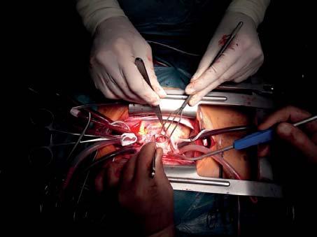 1 vegetace na jícnové echokardiografii, embolizační projevy infekční endokarditidy obr.2, obr. 3. Perioperační nález více než 3centimetrové vegetace in vivo a po explantaci viz obr. 4, resp. 5.