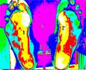 4.2 Vady nohou získané V průběhu života se stav našeho těla namáháním kosterního, vazivového a svalového systému mění. To vede k rozvoji vad nohy, které dále uvádíme. 4.2.1 Plochá noha Noha se v průběhu evoluce ještě nepřizpůsobila zcela vynucenému způsobu vzpřímené chůze.