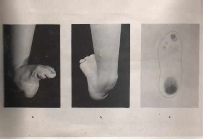 -noha hákovitá (pes calcaneus) Nejčastější příčinou této vady bývá ochrnutí lýtkového svalstva nebo porušením Achillovy šlachy.