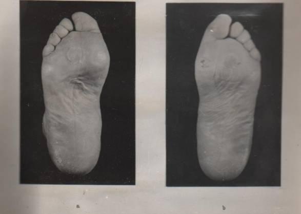 4.2.5 Kožní vady nohou - mozoly (clavi) Mozoly jsou zmnožení rohové vrstvy kůže, které se vytváří z nadměrného tlaku.