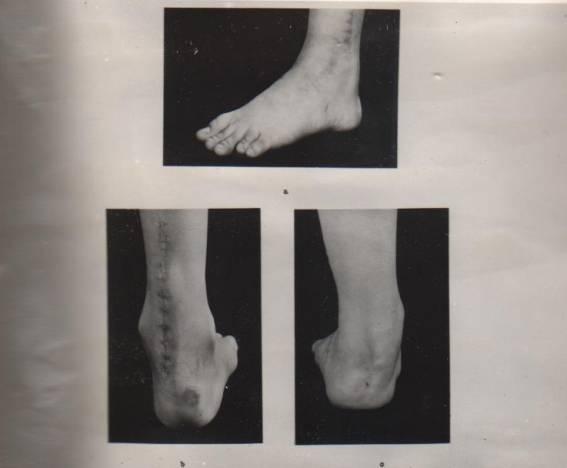 Puchýře vznikají prudkým opakovaným třením, nejčastěji zadní části paty, při dlouhé chůzi v příliš těsné nebo volné obuvi. Jsou bolestivé. 35,21 Obr.