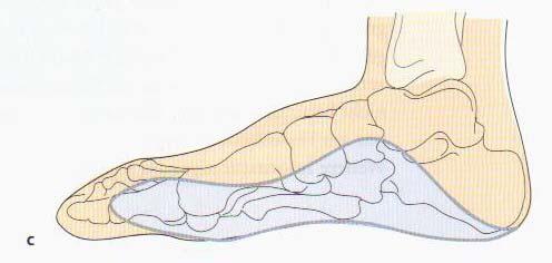 adductus noha deformovaná špičkou