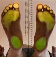 nohy, čím tmavší barva tím vyšší tlak v daném místě, slouží k přesnému zjištění a zaznamenání vad a k provedení odpovídajících korekcí Obr.