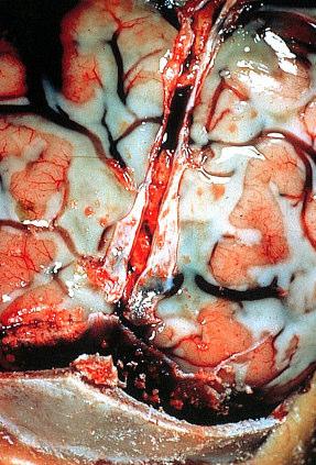 Meningitídy vírusové Enterovírusy Echovírus, Coxackie /Aug, Sept/ Mumps (koniec zimy, jar) Herpes simplex, Epstein-Barr Lymfocytárna choriomeningitída.